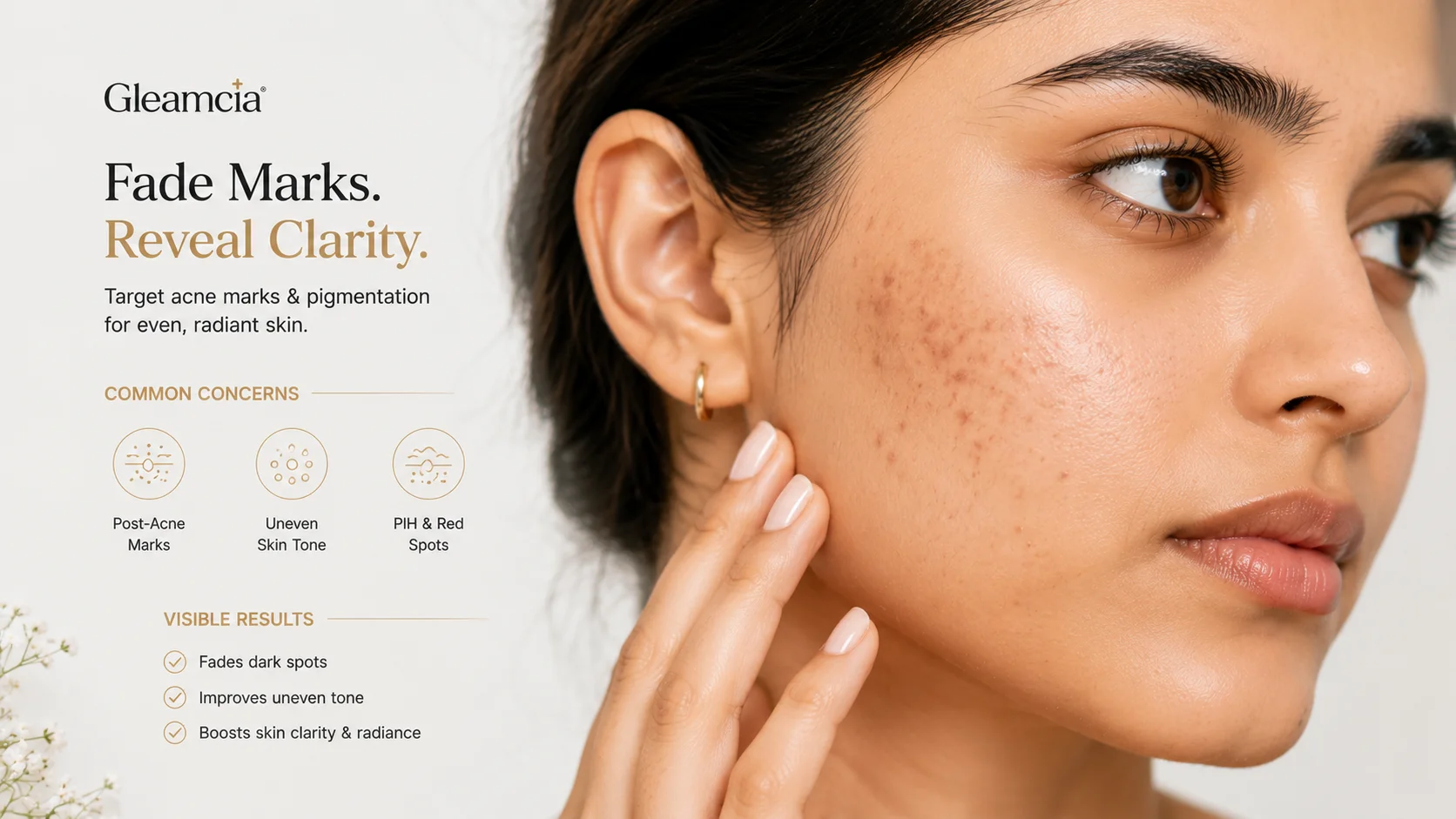 How to fade acne marks and post-inflammatory pigmentation on South Asian skin