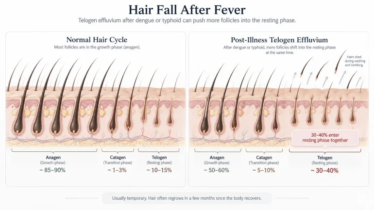 Why hair falls after dengue and typhoid fever — telogen effluvium diagram showing hair cycle disruption