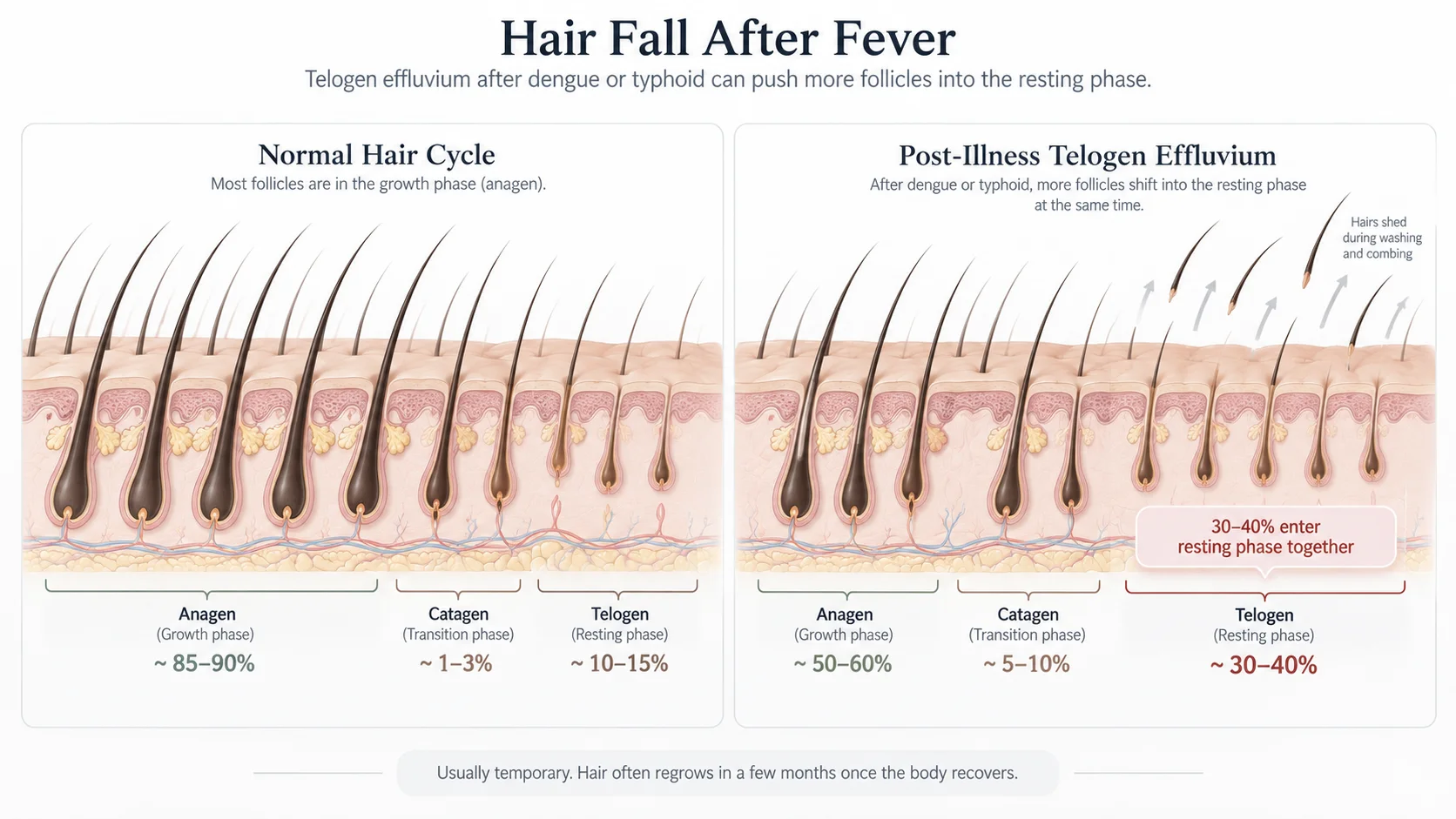 Why hair falls after dengue and typhoid fever — telogen effluvium diagram showing hair cycle disruption