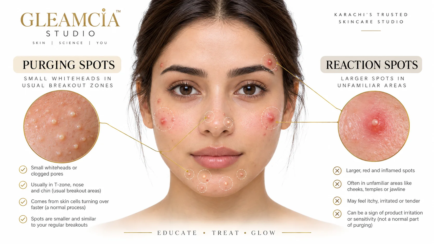 Skin purging vs breakout — where purging spots appear vs where a product reaction appears on the face